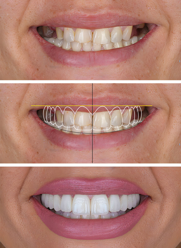 faccette-estetiche-zirconia Navibox tecnologia